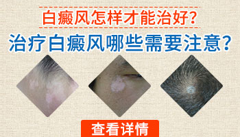 食疗可以治疗白癜风吗