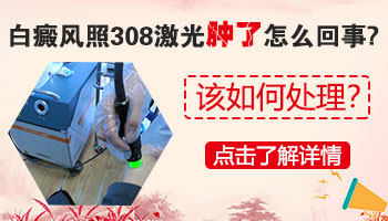 肚子上的白癜风怎么治疗比较好