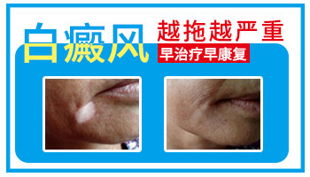 儿童白癜风适用的治疗方法有哪些