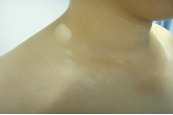 孕妇患上白癜风在生活中需要重视什么