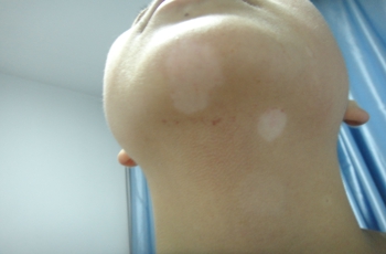 如何科学有效治疗白癜风呢