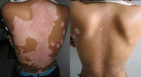 白癜风复发的原因有哪些