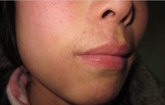 青少年唇部白癜风2个月治好