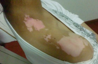 白癜风治疗避免出现哪些失误