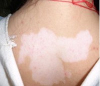 白癜风患者护理皮肤的注意事项是什么