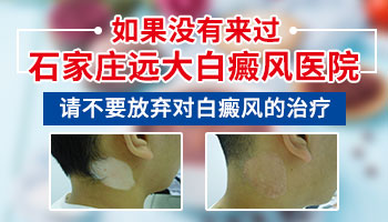 女性白癜风早期症状怎么治疗