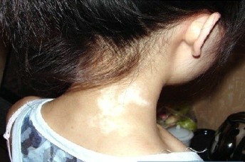 女性白癜风患病怎么治疗