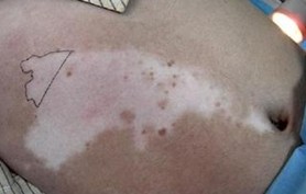 腰部白癜风不治的话会扩散吗