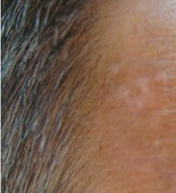 毛囊型白癜风治疗