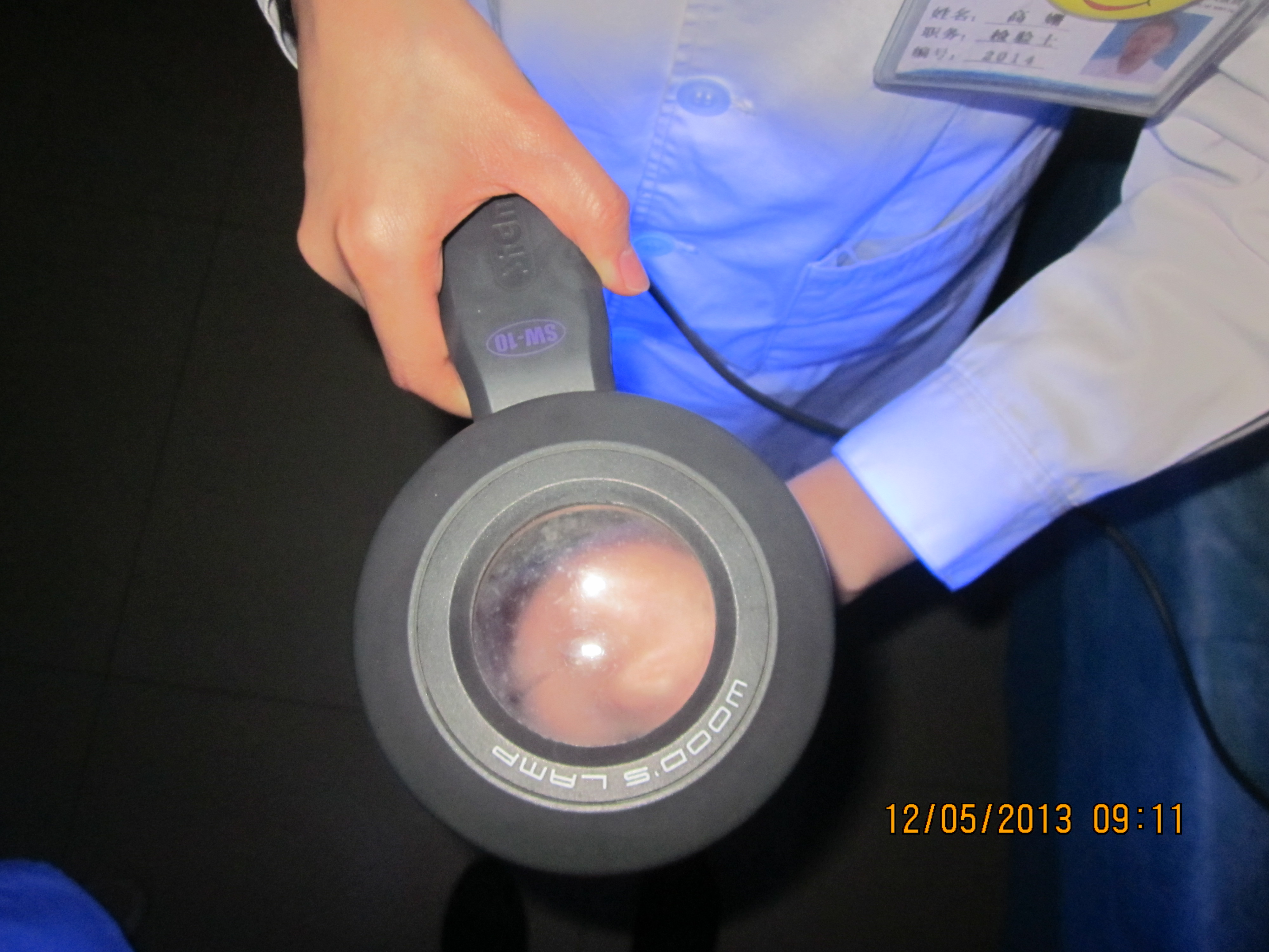 白斑一捏就变红了怎么回事