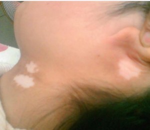 中秋节来临 白癜风患者要注意什么