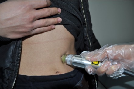 治白癜风308多久照一次