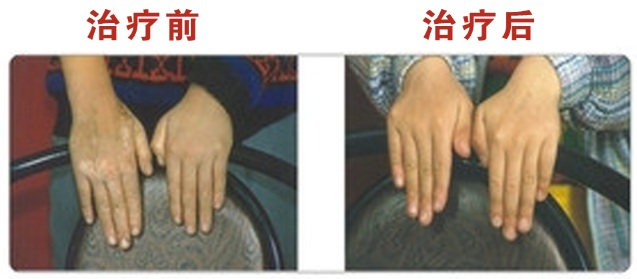 手部白癜风治疗对比图