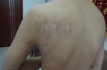 患上白癜风患者有什么变化吗