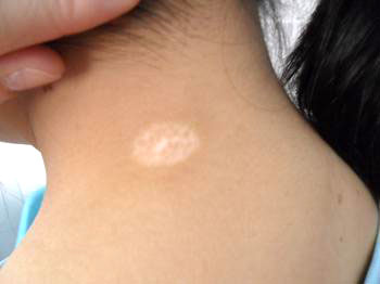 邯郸女性得了白癜风可以化妆吗