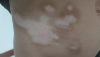 邢台人为什么会得白癜风呢