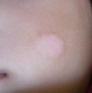 邢台脸上的白癜风症状怎么治疗