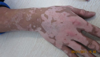 邯郸如何诊断自己得了白癜风