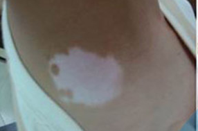 邢台白癜风医院治白癜风技术怎么样