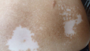 邢台缺乏微量元素会引起白癜风吗