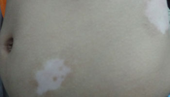 邯郸怎样判断才是不是白癜风