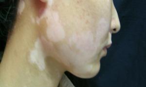 邯郸患者怎么护理脸上的白癜风