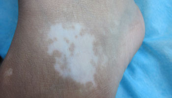 沧州白癜风医院有308准分子激光治疗仪吗