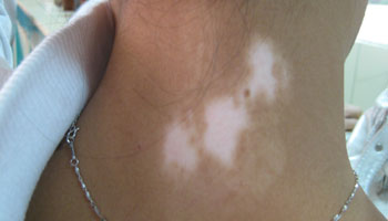 衡水引起白癜风外部因素有哪些