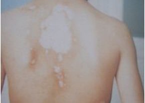 沧州专业治疗白癜风的医院在哪里