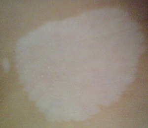 沧州患者患上白癜风可以使用遮盖霜吗