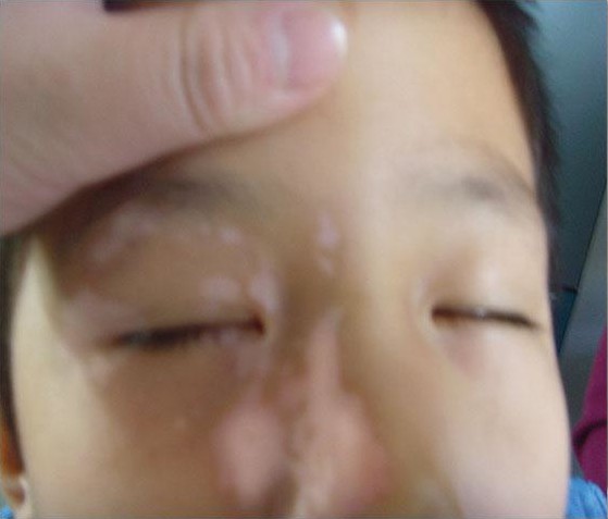沧州白癜风医院能做脸部植皮手术吗