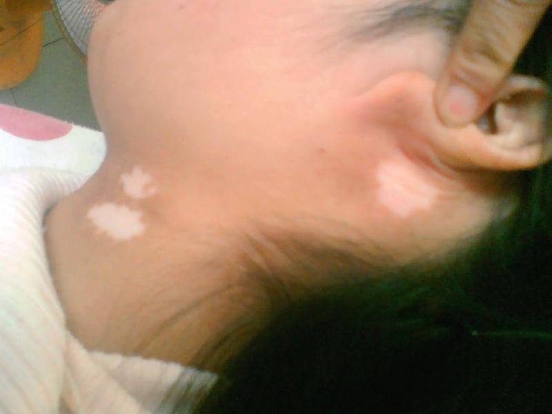 衡水孩子身上有白斑是白癜风吗