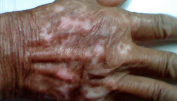 沧州白癜风医院能治好白癜风吗