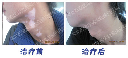 沧州白癜风医院好不