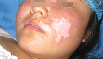 衡水哪家白癜风医院能治脸部白癜风