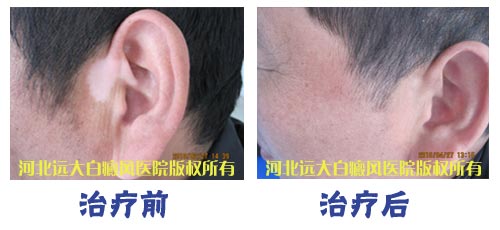 耳朵上的白癜风在沧州怎么治疗