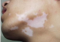 衡水激光治疗白癜风效果怎么样