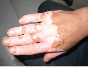 手上的白癜风病因在沧州能检查出来吗