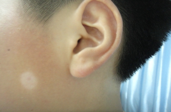 怎么才能发现早期的白癜风