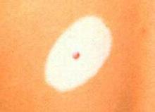 邯郸晕痣型白癜风哪家医院治的好呢