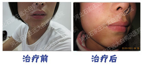 白癜风照光得多长时间