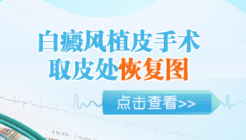 邯郸头皮白癜风会使整个头发变白