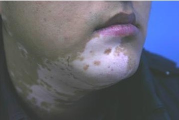 成人白癜风治疗需要注意什么