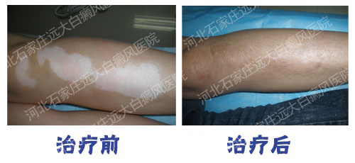 衡水哪里治疗白癜风效果明显