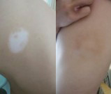 什么会影响白癜风的治疗呢