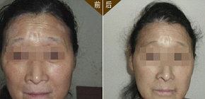 冬天激光治疗白癜风的费用会不会贵