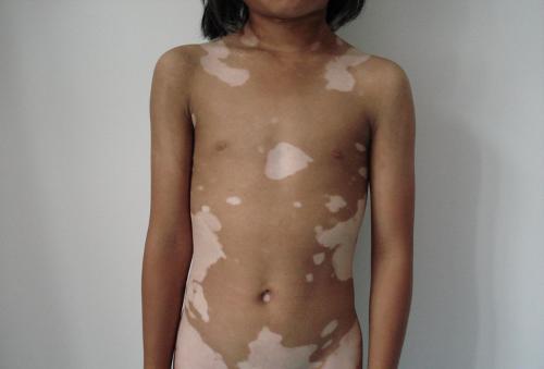 儿童大面积白癜风