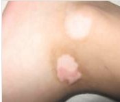 胳膊上长了不明显的白斑用治疗吗