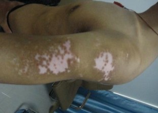 手臂白癜风很大不扩散能治好吗