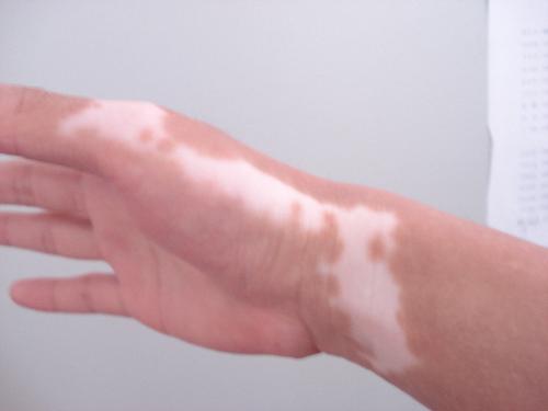 肢端型白癜风天津哪家医院治疗好
